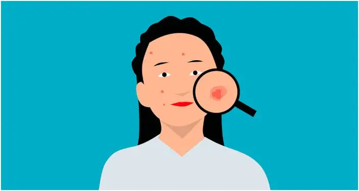 Salicylic Acid untuk Jerawat, Begini Cara Kerjanya